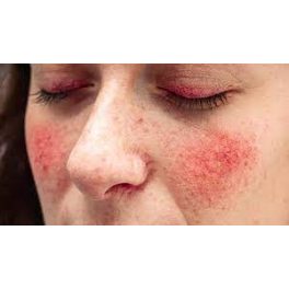 Rozacea